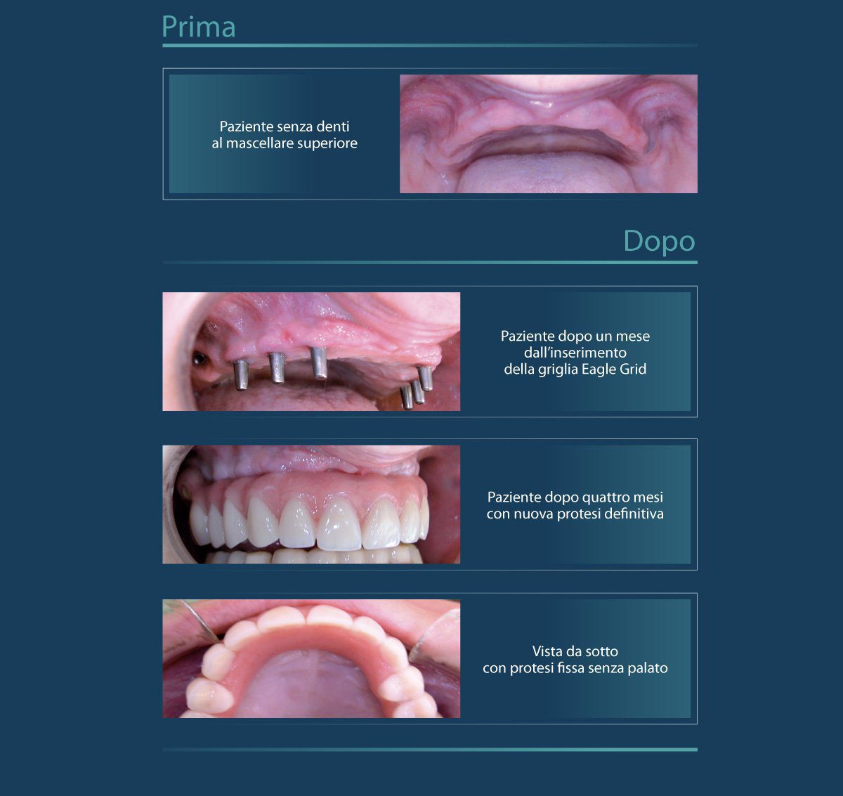 Protesi dentale Eagle Grid