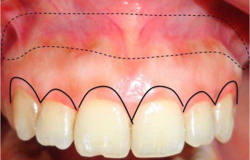 Il Gummy smile (o sorriso gengivale) non è altro che una ecessiva esposizione della gengiva rispetto ai denti. Come possiamo curare questo inestetismo?