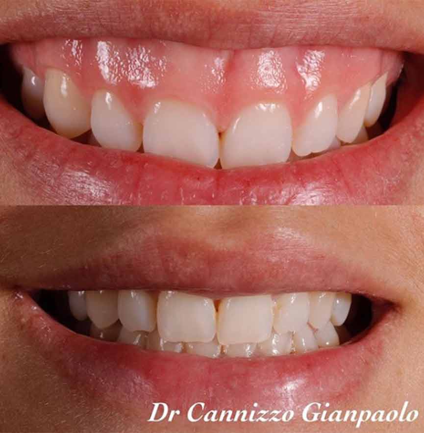 Sorriso Gengivale Cannizzo Studio Dentistico Milano