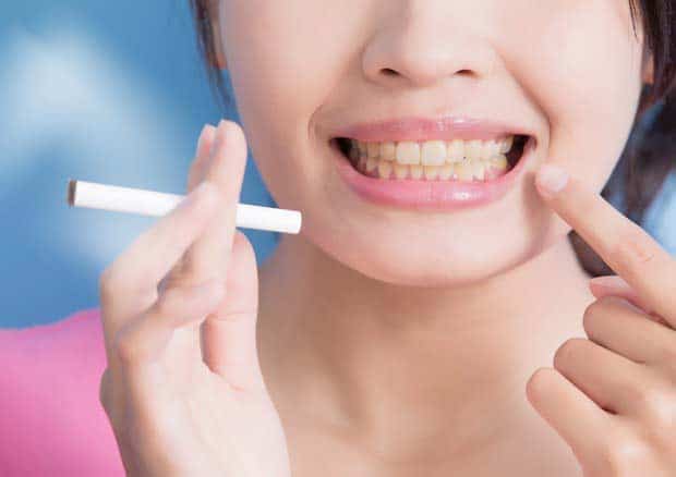 Implantologia dentale per chi fuma