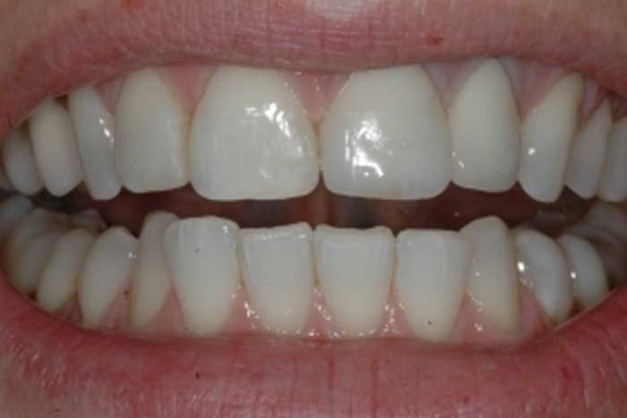 denti incisivi