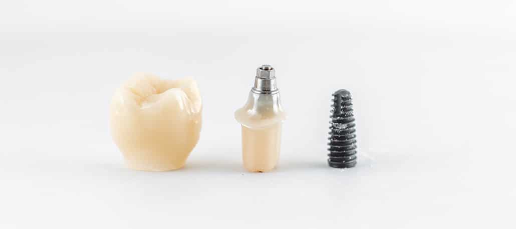Quanto dura un impianto dentale? Con il passare degli anni le tecniche di implantologia hanno avuto uno sviluppo tale da rendere la durata degli impianti pressoché illimitata