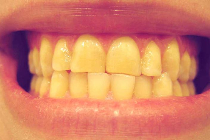 rimedi ai denti gialli