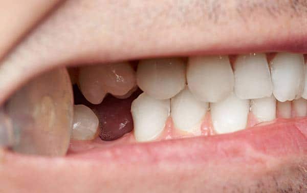 sostituire un dente perso