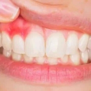 cisti dentale