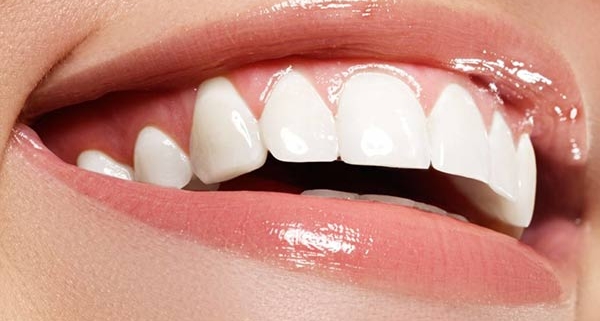 Trattamento al fluoro per i denti