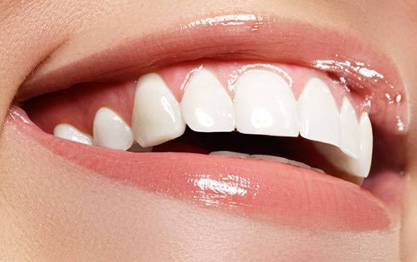 Trattamento al fluoro per i denti