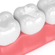Che cos'è la sigillatura dei denti?