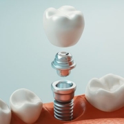 Impianto dentale con poco osso