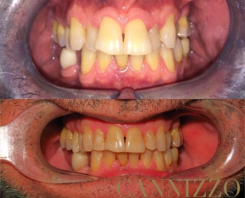 Invisalign prima e dopo, caso ortodonzia adulto