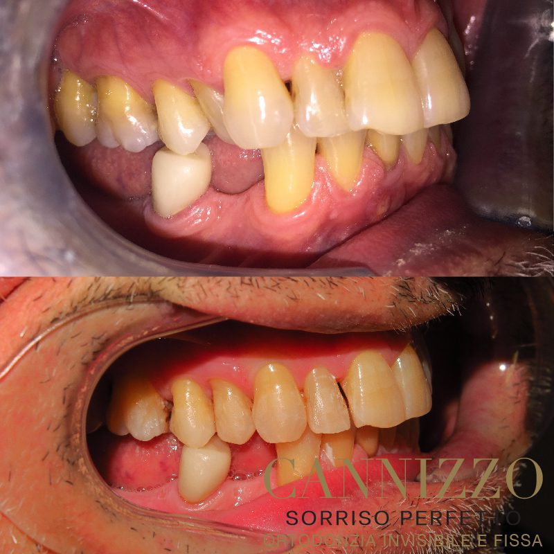Invisalign prima e dopo, caso ortodonzia adulto