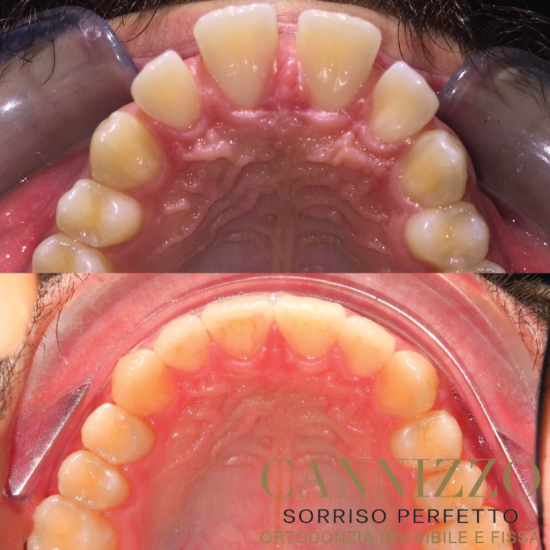 ortodonzia dentale caso prima e dopo invisalign