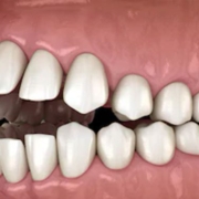 malocclusione dentale
