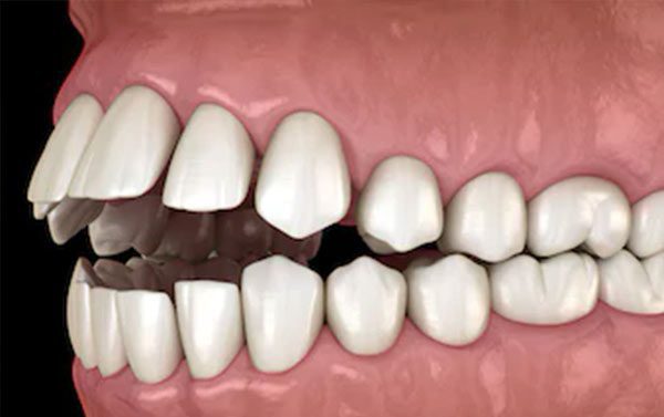 malocclusione dentale