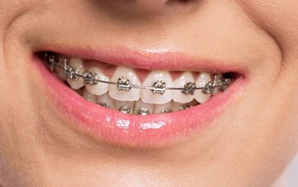 Tipologie di apparecchio ortodontico
