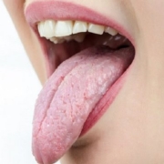 Mucosite orale
