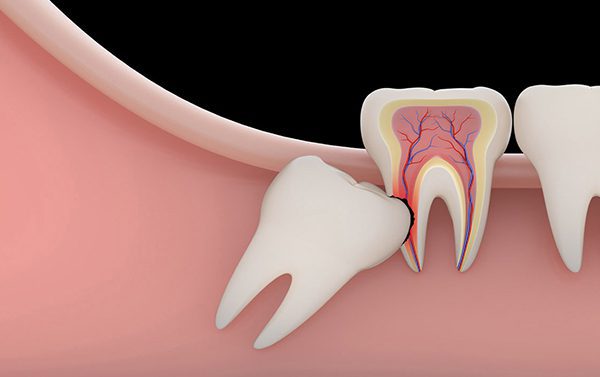 Denti inclusi