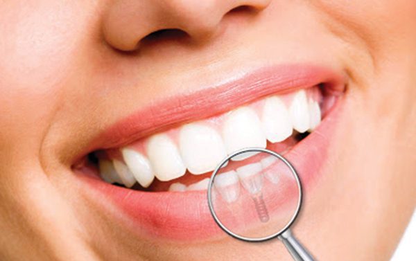 Impianto dentale: quello che devi sapere