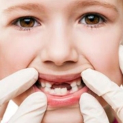 Malattia dentale rara: Anodontia