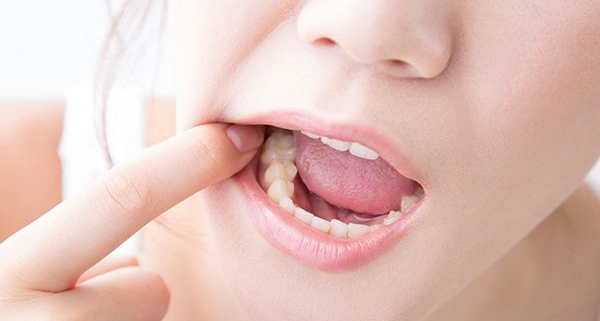 Gli stadi della carie dentale