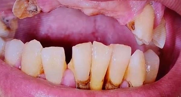 problemi impianto dentale