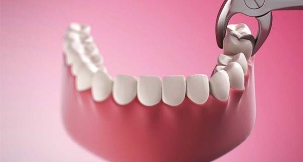 L'estrazione del dente fa male?