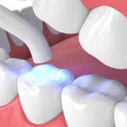 Diversi tipi di riempimenti dentali