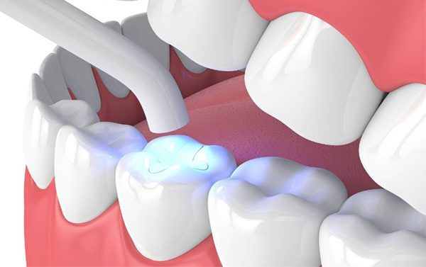 Diversi tipi di riempimenti dentali