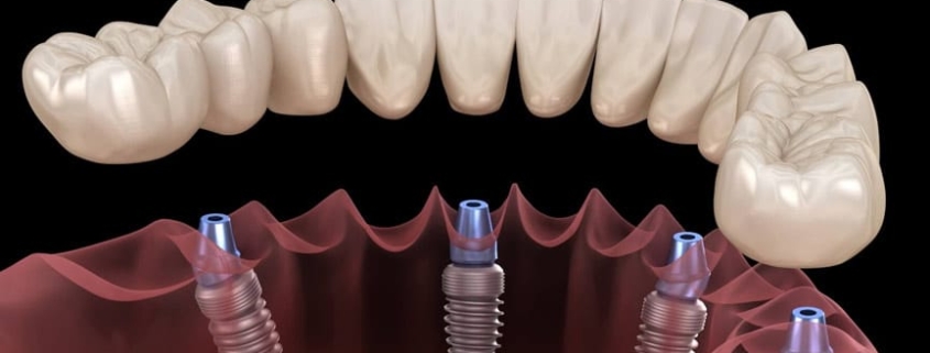 implantologia dentale è quella branca dell’odontoiatria che si occupa di sostituire i denti mancanti con un impianto. Cannizzo Milano