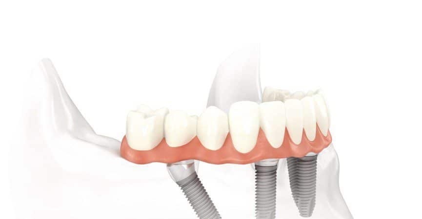 implantologia dentale è quella branca dell’odontoiatria che si occupa di sostituire i denti mancanti con un impianto. Cannizzo Milano