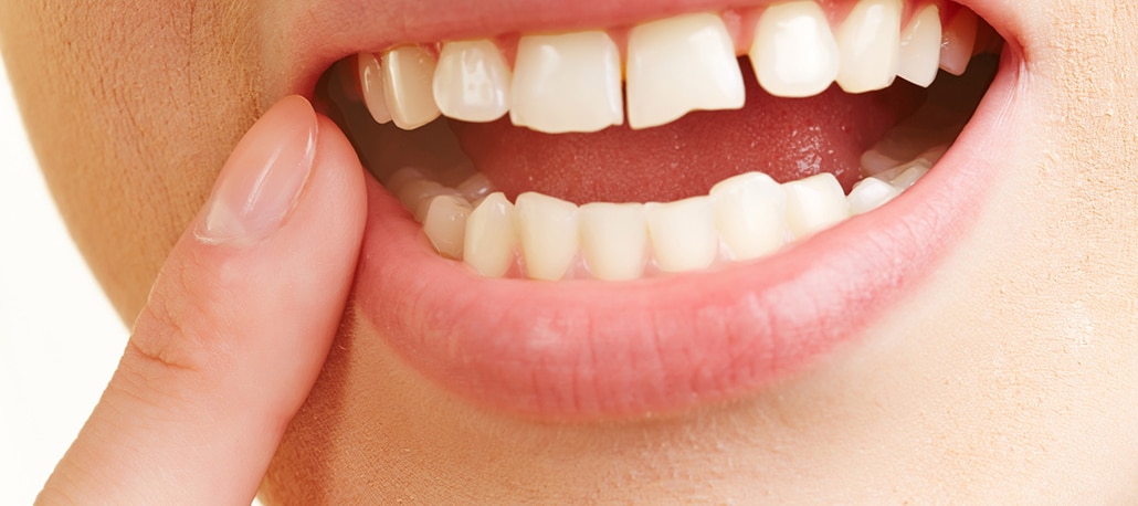 Come ricostruire lo smalto dentale: la demineralizzazione e la remineralizzazione dei denti. Cannizzo Studio Milano