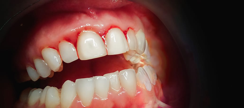Le malattie delle gengive, se non curate, possono portare anche alla perdita dei denti (parodontite). Cannizzo Studio Milano