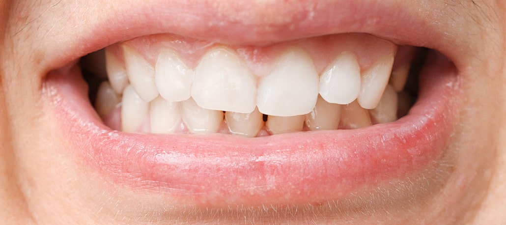 Cosa causa le macchie dentali
