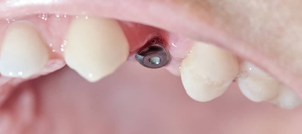 Quanti impianti sono necessari per sostituire tutti i denti?