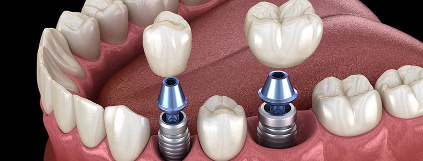 Implantologia dentale per sostituire denti mancanti, persi e intere arcate con un impianto dentale. Cannizzo Studio Milano