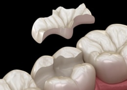 Intarsio dentale: cos'è, come funziona e quali sono i vantaggi