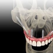 L'implantologia zigomatica: una soluzione per i pazienti con ridotta densità ossea