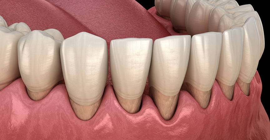 Impianti dentali e malattia parodontale: considerazioni e interazioni