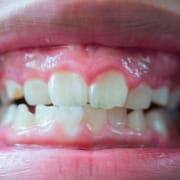 Denti consumati: cause e rimedi dell’erosione dentale