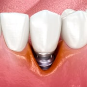 Le malattie peri-implantari emergono come una preoccupazione sempre più rilevante a minaccia dell'impianto dentale.