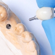 L'implantologia mini-invasiva è una procedura chirurgica avanzata utilizzata per sostituire i denti mancanti con impianti dentali