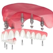 Impianto dentale: tutto quello che devi sapere