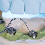 L'Impianto endosseo rientra nell'implantologia, riferendosi a un impianto dentale inserito chirurgicamente nella mascella.