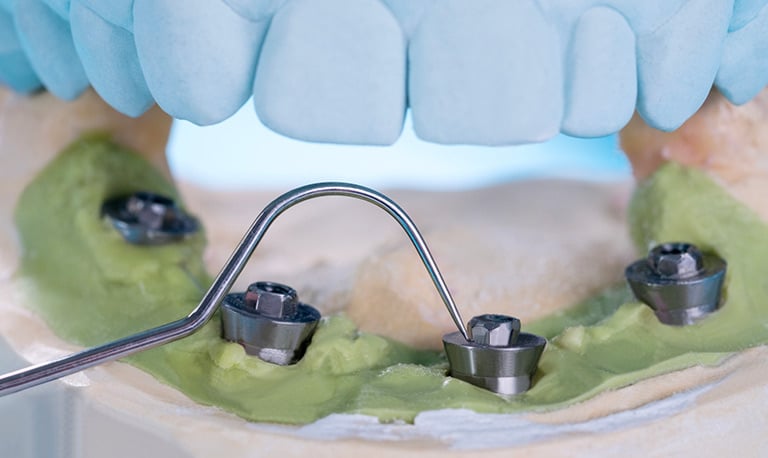 L'Impianto endosseo rientra nell'implantologia, riferendosi a un impianto dentale inserito chirurgicamente nella mascella.