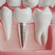 Cosa fare con poco osso dentale: consigli utili | Cannizzo Studio