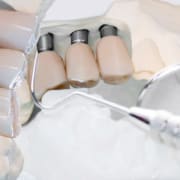 L'integrazione ossea per un impianto dentale