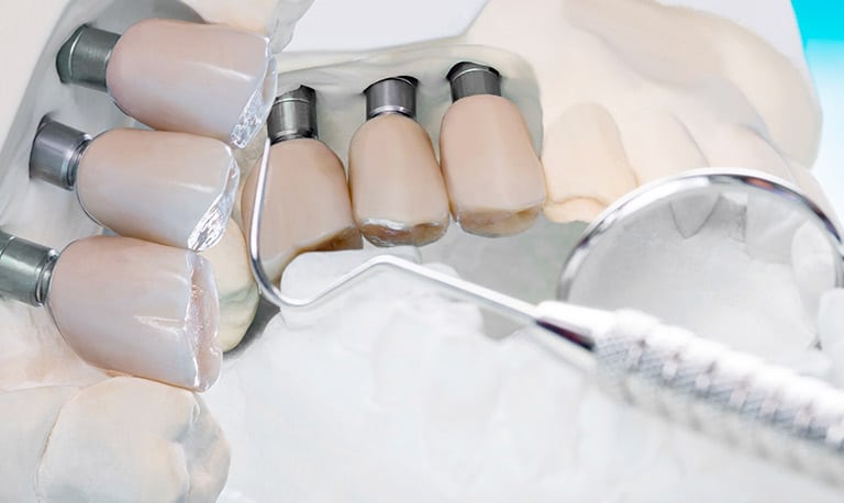 L'integrazione ossea per un impianto dentale