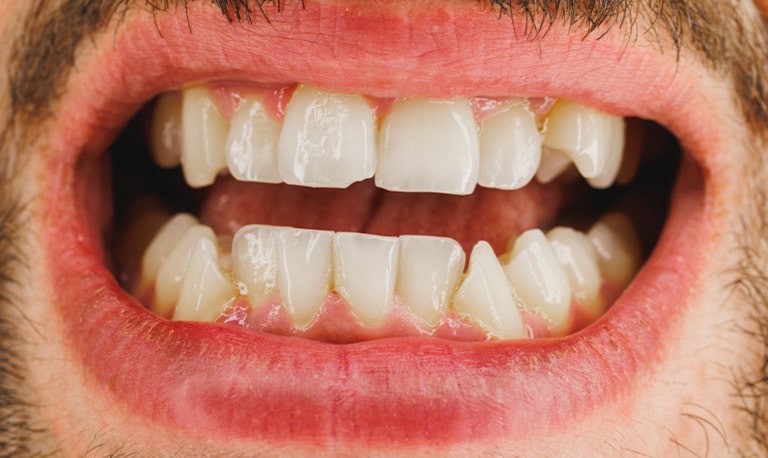 Dente spezzato: percorso di cura e ripristino estetico e funzionale