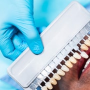 Alternative alle faccette dentali: scopri le opzioni per il tuo sorriso