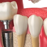 Implantologia guidata: come cambia il mondo degli impianti dentali